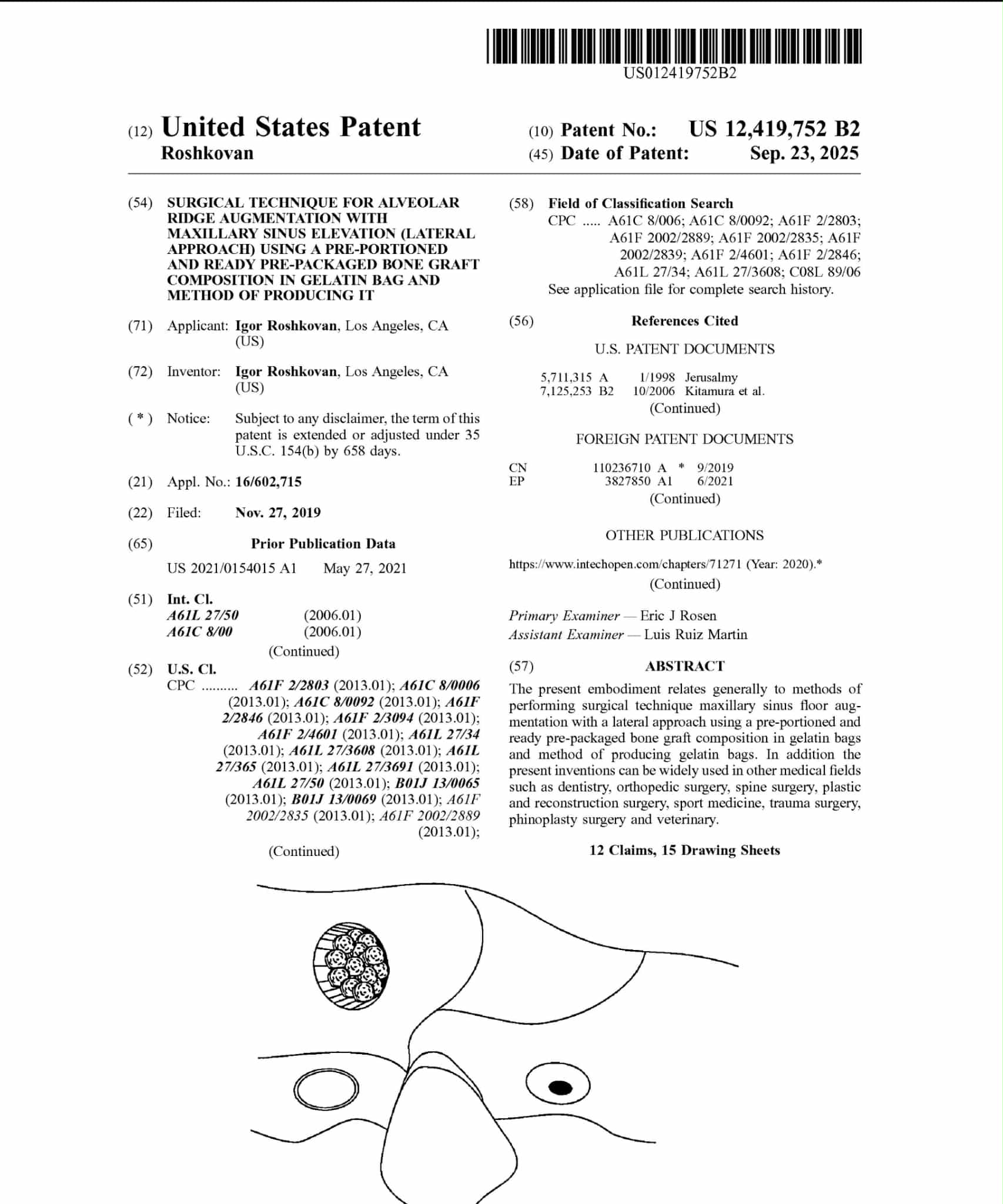 First page of United States Patent US 12,419,752 B2 with an anatomical drawing of maxillary sinus elevation.